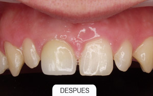 implantes dentales. caso unico