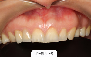 implantes dentales. puente de 2 piezas