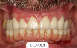 implantes dentales. rehabilitaciones complejas