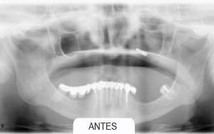 implantes dentales. sin hueso suficiente