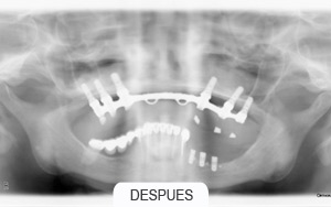 implantes dentales. sin hueso suficiente