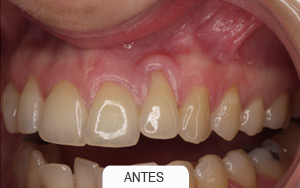 implantes dentales. rehabilitaciones complejas