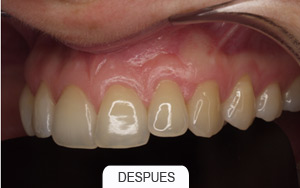 implantes dentales. rehabilitaciones complejas